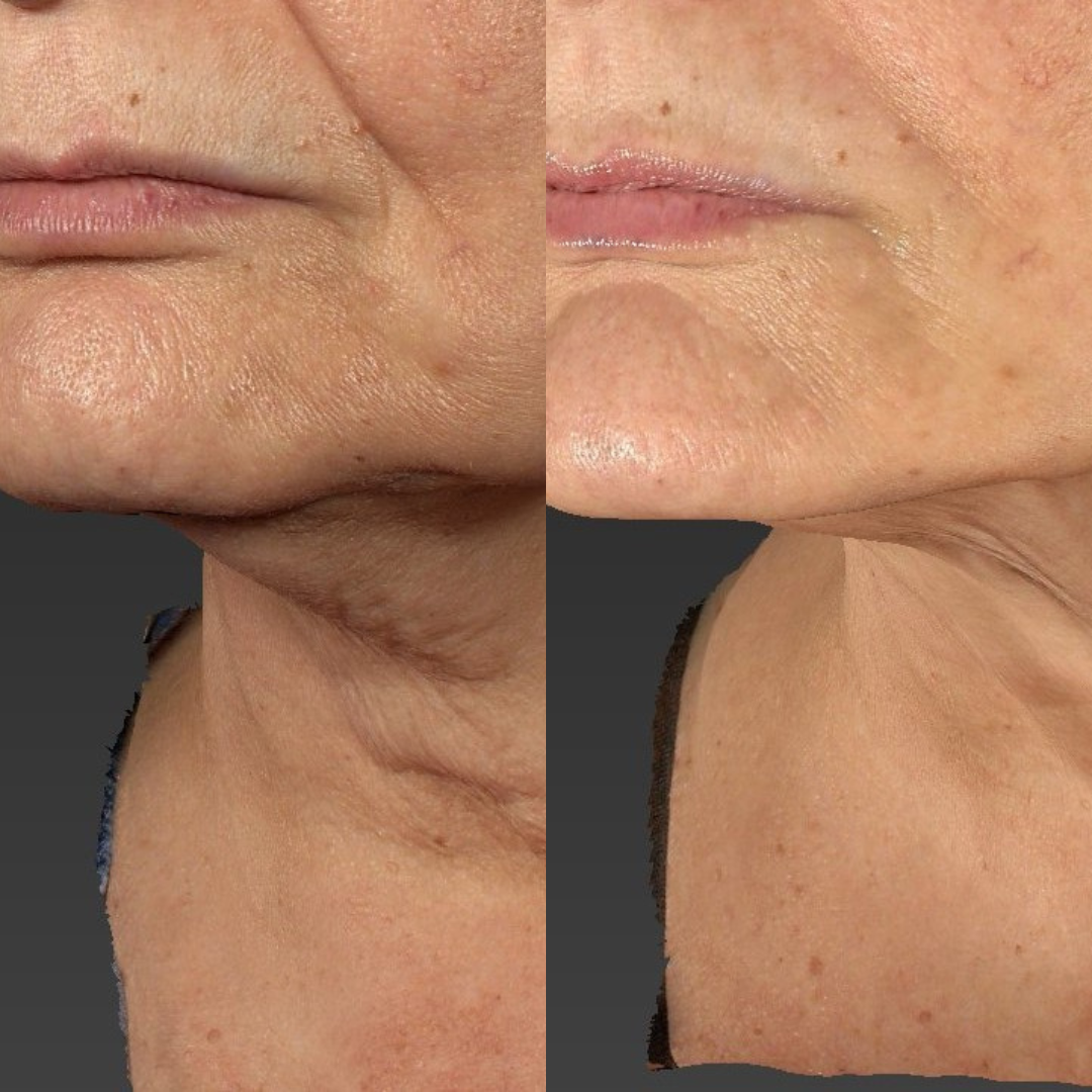 Neck skin tightening before and after.