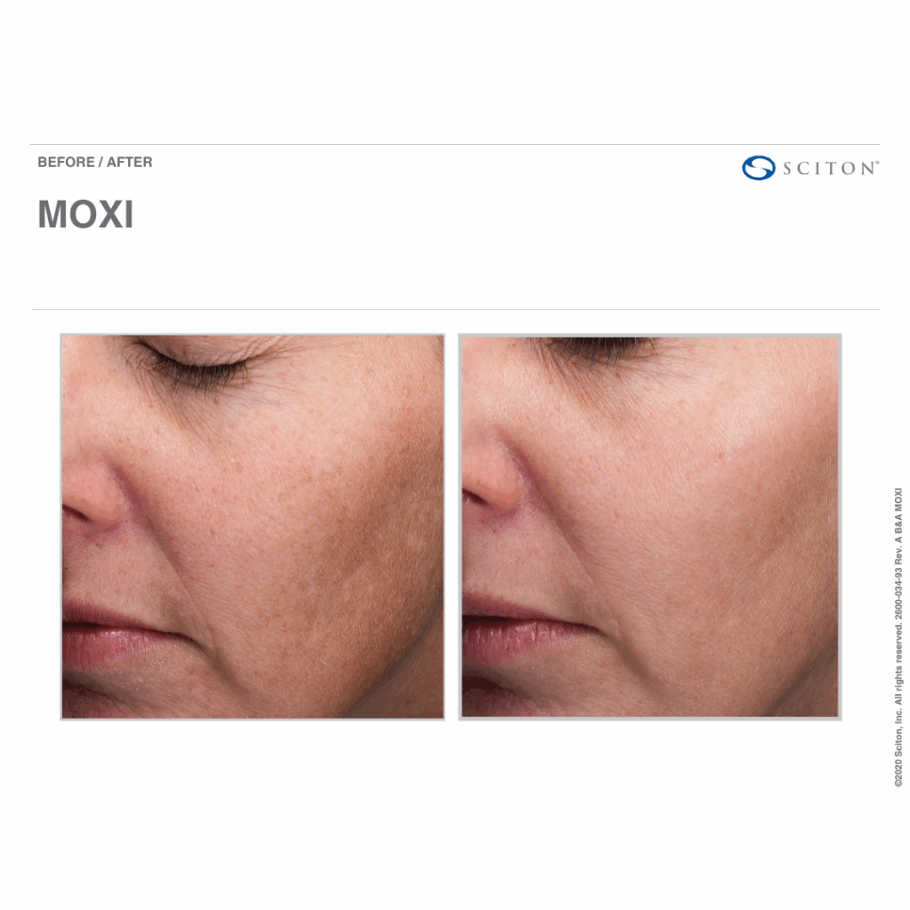MOXI Before & After