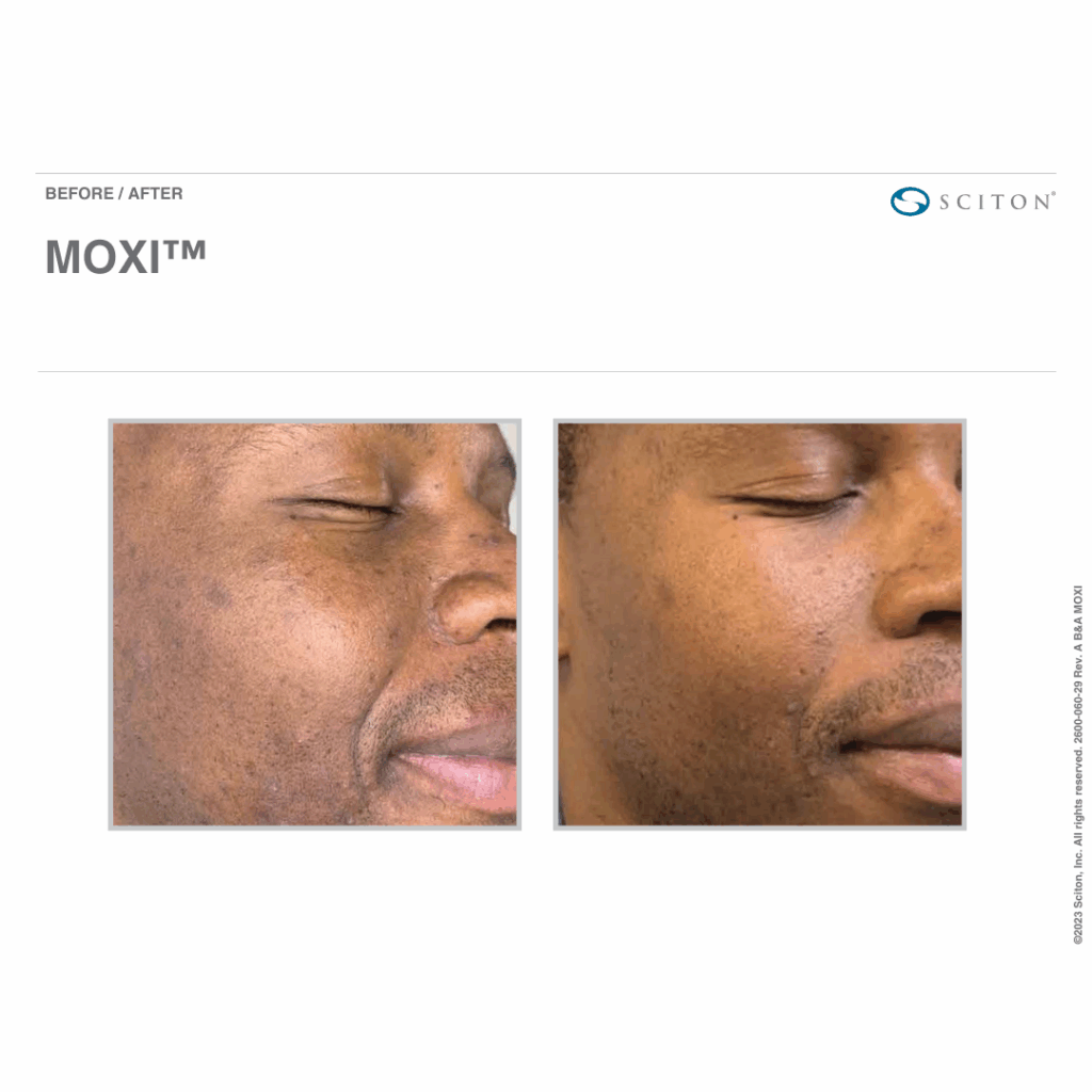 MOXI Before & After