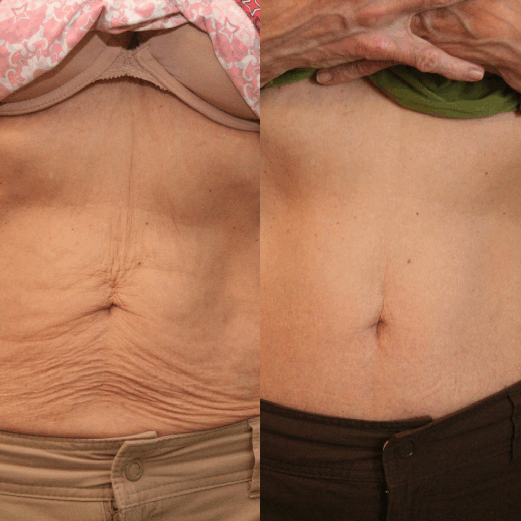 Stomach skin tightening before and after Sydney