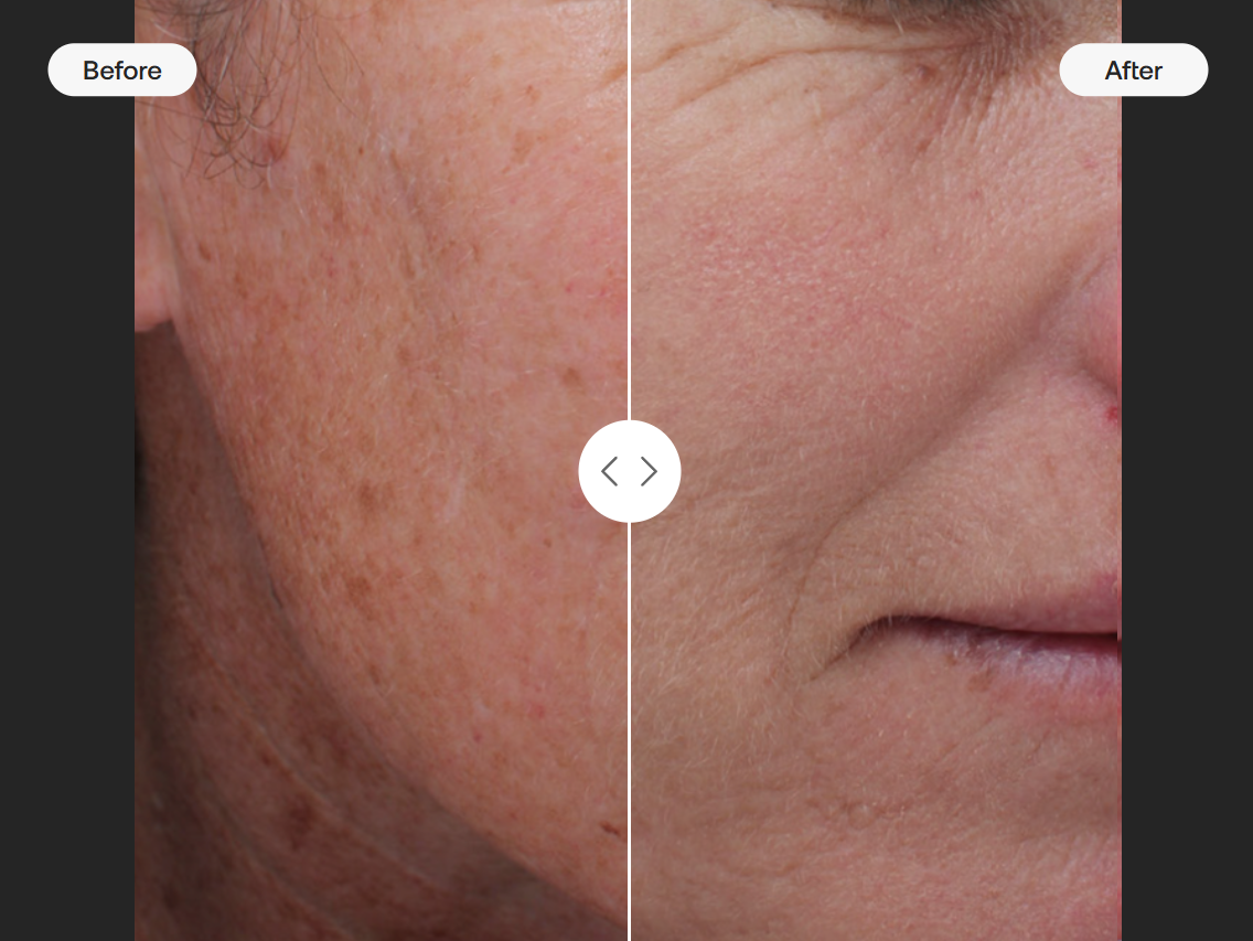 BBL Moxi Before and After